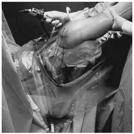 Solventum Steri-Drapetm U-Drapes - U-Slot Aperture – image 2