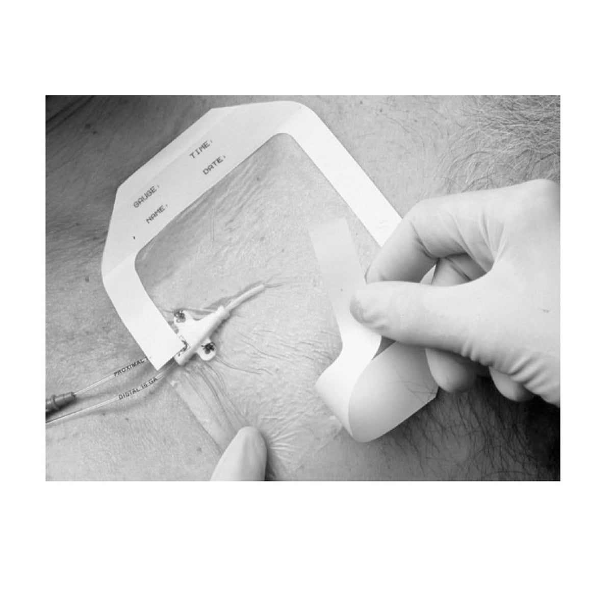 Solventum Tegadermtm Transparent Film Dressing - Frame Style Dressing